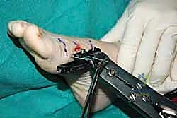 صورة طبية: إطالة مشط القدم الأول لعلاج إبهام القدم الأروح المرتجع: حل نهائي لآلام القدم المزمنة في صنعاء