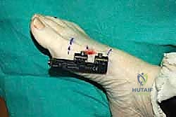 استخدام أحدث التقنيات الجراحية والم
![صورة طبية: إطالة مشط القدم الأول لعلاج إبهام القدم الأروح المرتجع: حل نهائي لآلام القدم المزمنة في صنعاء