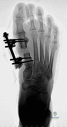 صورة طبية: إطالة مشط القدم الأول لعلاج إبهام القدم الأروح المرتجع: حل نهائي لآلام القدم المزمنة في صنعاء