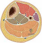 أعراض وعلامات كسور الساق