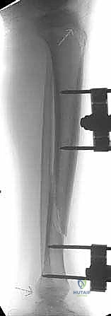 التدخل الجراحي لكسور الساق