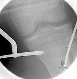 مرحلة التأهيل والعلاج الطبيعي