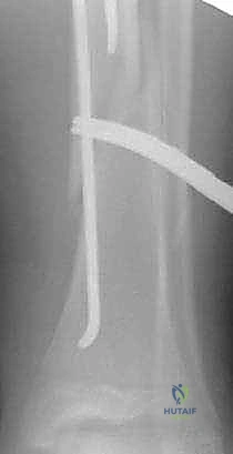 خطوات العملية الجراحية - الجزء الأول