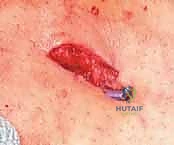 أسباب كسور قصبة الساق الشائعة