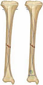 صورة توضيحية لـ كسور قصبة الساق لدى الأطفال: دليل شامل للآباء والعلاج المتطور مع الأستاذ الدكتور محمد هطيف في صنعاء