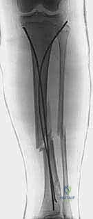 صورة توضيحية لـ كسور قصبة الساق لدى الأطفال: دليل شامل للآباء والعلاج المتطور مع الأستاذ الدكتور محمد هطيف في صنعاء