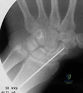 صور أشعة مقطعية توضح تخطيط كسر الزورقي قبل الجراحة