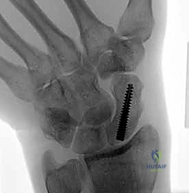 توضيح لتقنية التثبيت عن طريق الجلد والأدوات المستخدمة