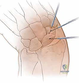 صورة توضيحية لـ تثبيت كسر الزورقي عن طريق الجلد: دليل شامل للمرضى مع الأستاذ الدكتور محمد هطيف