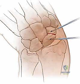تثبيت كسر الزورقي عن طريق الجلد: دليل شامل للمرضى مع الأستاذ الدكتور محمد هطيف