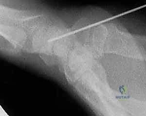 Illustration of fixation of acute - Dr. Mohammed Hutaif