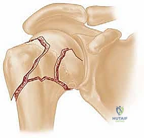Illustration of pinning for proximal - Dr. Mohammed Hutaif