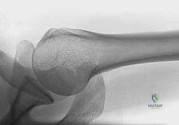 Illustration of pinning for proximal - Dr. Mohammed Hutaif