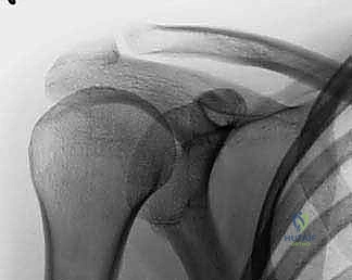 COMPLICATIONS OF FRACTURES