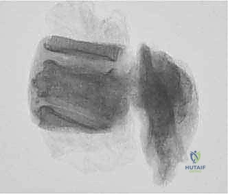 Illustration of total en bloc - Dr. Mohammed Hutaif