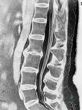 مراحل تنكس القرص الفقري