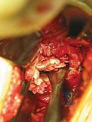 تأثير النتوءات العظمية على الأعصاب