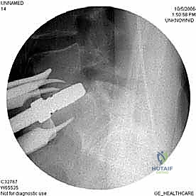 إزالة القرص الفقري التالف