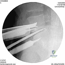 صورة طبية: دمج الفقرات القطنية الأمامي واستئصال الجسم الفقري: حلول متقدمة لآلام الظهر المزمنة مع الأستاذ الدكتور محمد هطيف في صنعاء