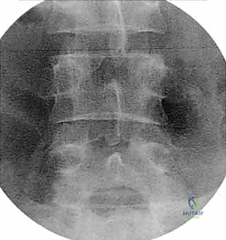 أسباب اللجوء لاستئصال الجسم الفقري