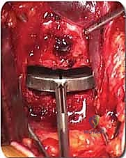 صورة توضيحية لـ دمج الفقرات القطنية الأمامي واستئصال الجسم الفقري: حلول متقدمة لآلام الظهر المزمنة مع الأستاذ الدكتور محمد هطيف في صنعاء