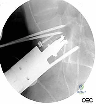 صورة طبية: دمج الفقرات القطنية الأمامي واستئصال الجسم الفقري: حلول متقدمة لآلام الظهر المزمنة مع الأستاذ الدكتور محمد هطيف في صنعاء