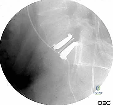 صورة طبية: دمج الفقرات القطنية الأمامي واستئصال الجسم الفقري: حلول متقدمة لآلام الظهر المزمنة مع الأستاذ الدكتور محمد هطيف في صنعاء