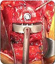 الشق الجراحي في البطن