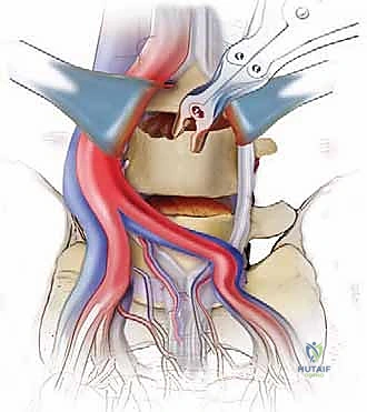 زراعة القفص القابل للتمدد لدعم العمود الفقري