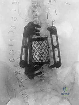 صورة توضيحية لـ دمج الفقرات القطنية الأمامي واستئصال الجسم الفقري: حلول متقدمة لآلام الظهر المزمنة مع الأستاذ الدكتور محمد هطيف في صنعاء