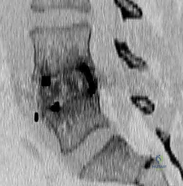 استئصال الجسم الفقري التالف