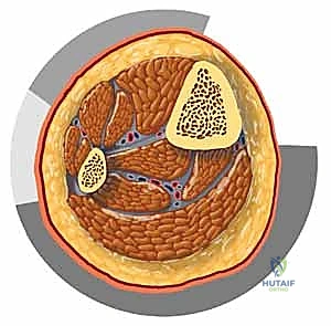 أسباب متلازمة الحيز وتأثير الكسور على زيادة الضغط