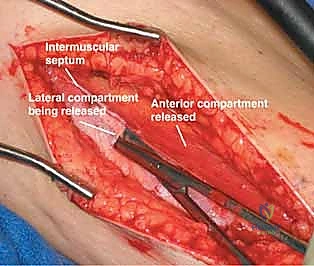 التشريح الدقيق لحجرات الساق العضلية وارتباطها بمتلازمة الحيز