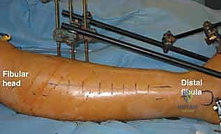 متلازمة الحيز الحادة في الساق: دليل شامل لجراحة بضع اللفافة مع الأستاذ الدكتور محمد هطيف