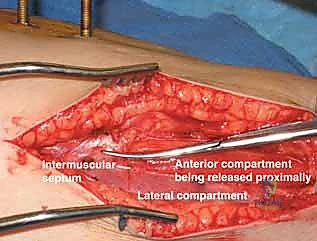 استخدام أجهزة قياس الضغط داخل حجرات الساق