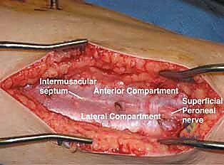 المضاعفات الجهازية لمتلازمة الحيز على الكلى والقلب