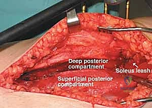 صورة توضيحية لـ متلازمة الحيز الحادة في الساق: دليل شامل لجراحة بضع اللفافة مع الأستاذ الدكتور محمد هطيف