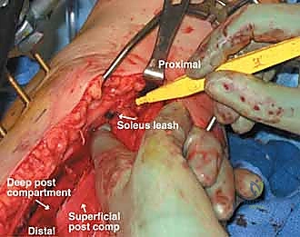 صورة توضيحية لـ متلازمة الحيز الحادة في الساق: دليل شامل لجراحة بضع اللفافة مع الأستاذ الدكتور محمد هطيف