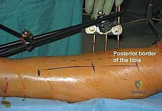 إجراء الشق الخارجي لتحرير الحيز الأمامي والجانبي