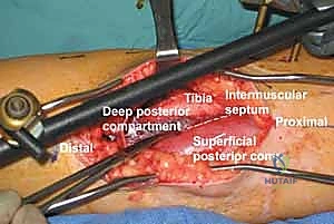تخطيط الشقوق الجراحية على ساق المريض