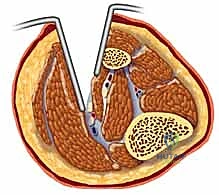 صورة توضيحية لـ متلازمة الحيز الحادة في الساق: دليل شامل لجراحة بضع اللفافة مع الأستاذ الدكتور محمد هطيف