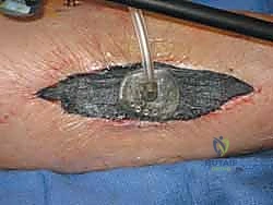 إجراء الشق الداخلي لتحرير الحجرات الخلفية