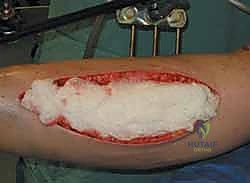 صورة طبية: متلازمة الحيز الحادة في الساق: دليل شامل لجراحة بضع اللفافة مع الأستاذ الدكتور محمد هطيف