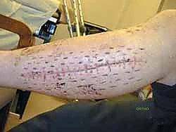 صورة توضيحية لـ متلازمة الحيز الحادة في الساق: دليل شامل لجراحة بضع اللفافة مع الأستاذ الدكتور محمد هطيف