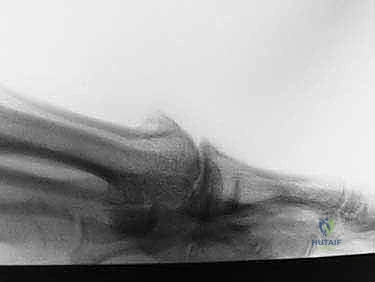 Moberg Osteotomy & Cheilectomy: A Masterclass in Hallux Rigidus Correction