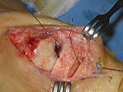 Illustration of moberg osteotomy moberg - Dr. Mohammed Hutaif