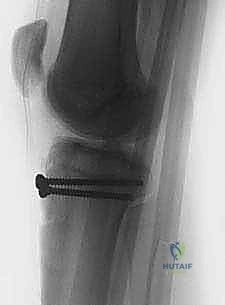 صورة توضيحية للتشريح الحيوي للركبة وحدبة الظنبوب