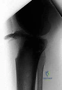 صورة توضيحية لـ كسر حدبة الظنبوب: دليل شامل لعلاج الرد المفتوح والتثبيت الداخلي مع الأستاذ الدكتور محمد هطيف في صنعاء