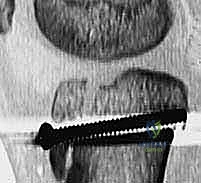 التشخيص الشعاعي لكسر حدبة الظنبوب