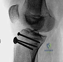 صورة توضيحية لـ كسر حدبة الظنبوب: دليل شامل لعلاج الرد المفتوح والتثبيت الداخلي مع الأستاذ الدكتور محمد هطيف في صنعاء